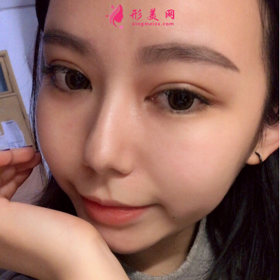 深圳非凡整形医院梅够明隆鼻手术