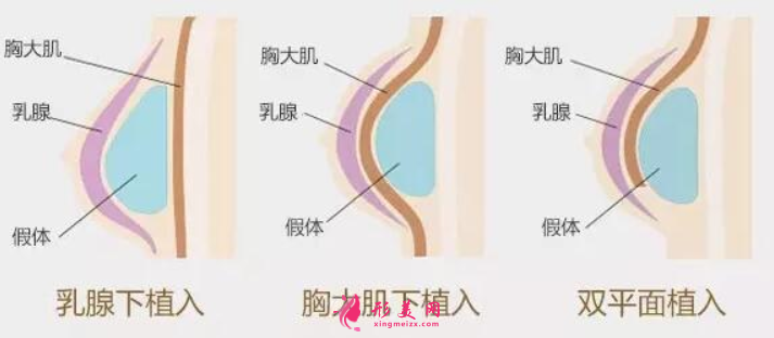 假体隆胸成本受什么原因影响