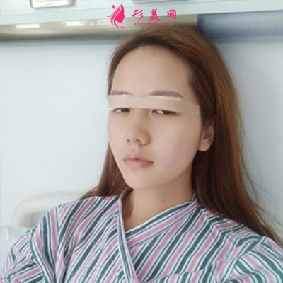 上海东方丽人整形医院吴建明双眼皮案例