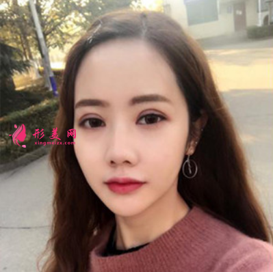 上海东方丽人整形医院吴建明双眼皮案例