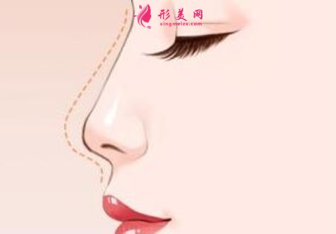 哪里做隆鼻手术会比较好