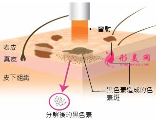 激光祛斑多少天可以洗脸