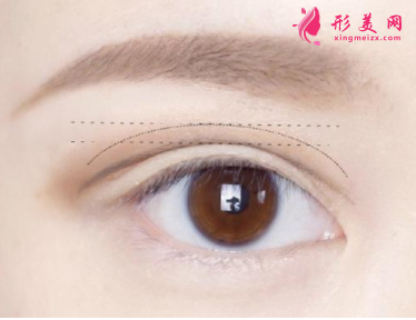 双眼皮术后怎么做可以加快消肿