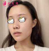 重庆美伽整形医院磨骨案例分享，轻松瘦成小V脸