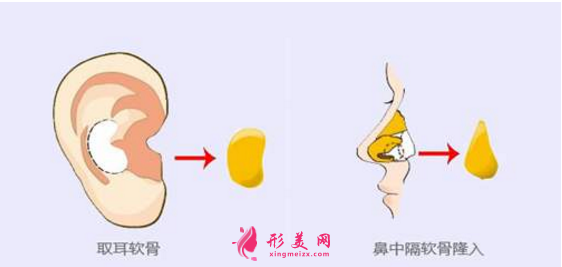 自体软骨隆鼻尖价格是多少？术后需要注意的地方~