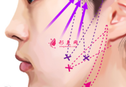 脸部埋线提升后吃东西有影响吗