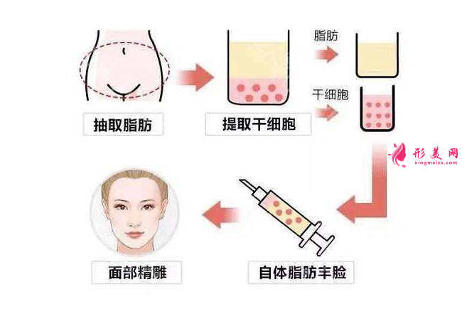 自体脂肪填充泪沟