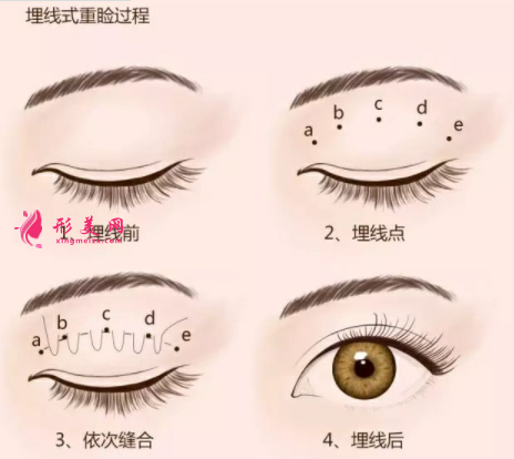 埋线眼睛皮术后要如何护理？