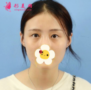 郑州附二院整形科眼综合真人案例，眼型线条很流畅 简直美翻