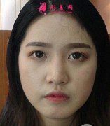 成都艺星硅胶垫鼻梁怎么自拍怎么好看