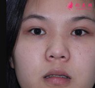 北京刘彦军韩式分段隆鼻案例：1-15天的变化对比图