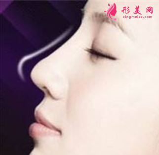 自体软骨隆鼻的价格是多少