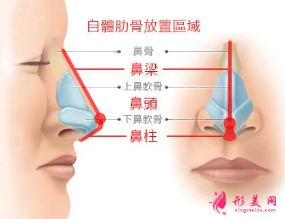 肋软骨隆鼻成效能管多长时间