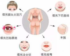 自体脂肪填充后遗症有哪些？