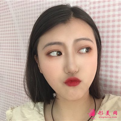 厦门切开双眼皮手术恢复情况对比