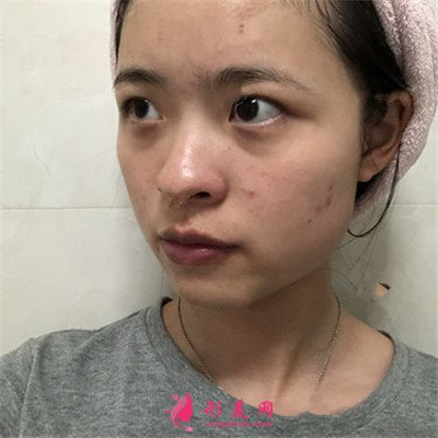 深圳眼综合术后恢复案例分享