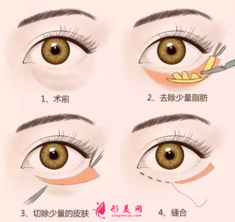 眼袋手术大概需要多少钱？