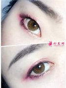 不适合做双眼皮手术的人群有哪些？