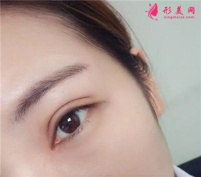 三种割眼睛皮手术的办法，你了解哪一种