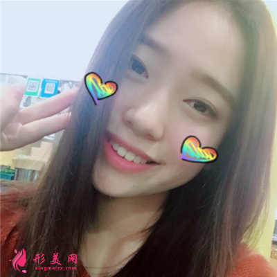 海南小姐姐吸脂瘦脸术后案例反馈