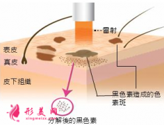 激光祛黄褐斑还会再长吗？