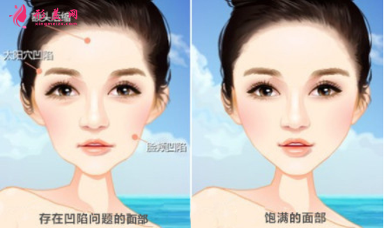 自体脂肪填充脸部可以保持多久