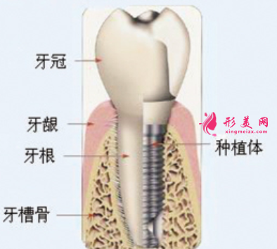 种植牙可以用多长时间