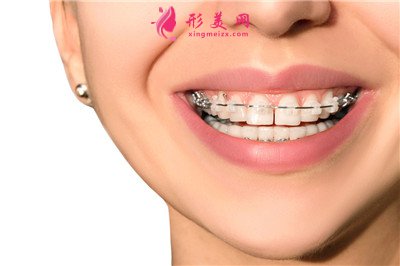 成年人能否矫正牙齿？