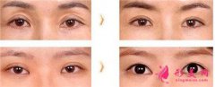 双眼皮术后疤痕不消的原因有哪些？