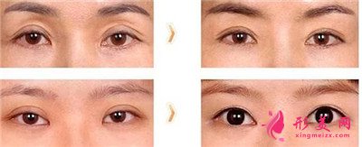 眼睛皮术后疤痕不消是什么原因有什么？