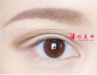 切开眼睛皮术后的护理工作如何做