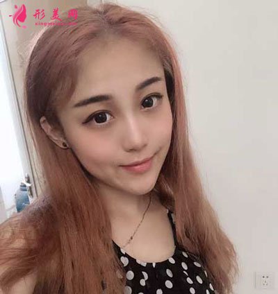 西安美莱整形美容医院隆鼻手术的案例