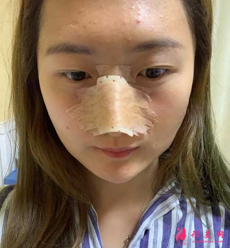 大连医科大学第二附属医院整形外科做隆鼻一个月经历分享