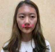 大连医科大学第二附属医院整形外科做隆鼻一个月经历分享