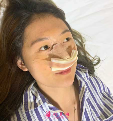 大连医科大学第二附属医院整形外科做隆鼻一个月经历分享