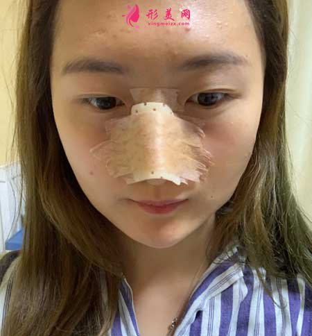 大连医科大学第二附属医院整形外科做隆鼻一个月经历分享