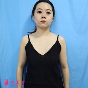 重庆联合丽格美容医院小仙女自体脂肪隆胸恢复效果反馈