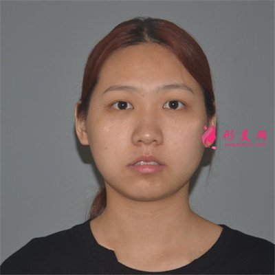 长沙小姐姐吸脂瘦脸术后恢复效果分享