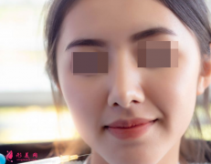 自体脂肪填充脸部价格大概是多少？