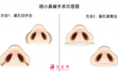 鼻翼缩小手术的价格费用是多少?