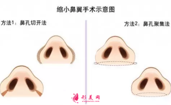 鼻翼缩小手术的价格成本是多少?