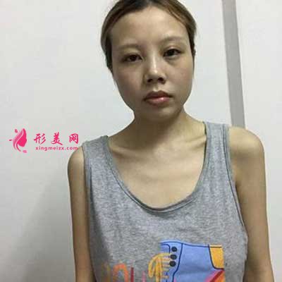 去北京丽都医疗美容医院做自体脂肪隆胸手术前