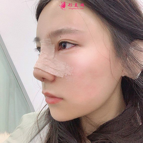 立场简单的整形术后图片
