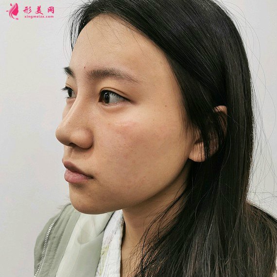 整形前后对比图片