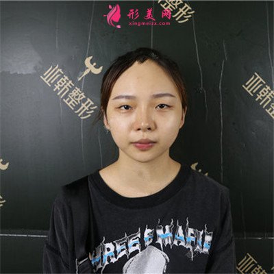 武汉小姐姐的眼综合术后效果展示