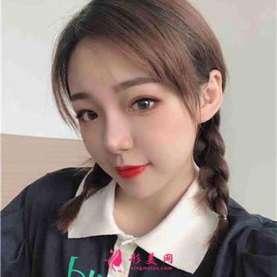 武汉小姐姐的眼综合术后效果展示