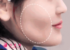 自体脂肪填充脸部手感怎么样？
