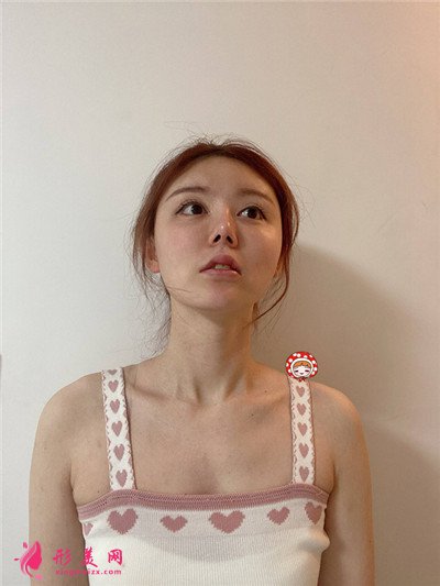 郑州做M唇手术术后恢复效果反馈