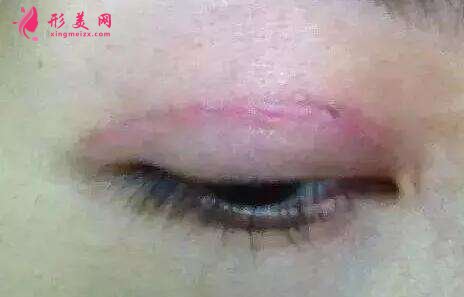 眼睛皮术后一个月疤痕明显如何解决