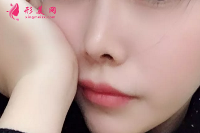 做鼻翼缩小手术需要注意的地方